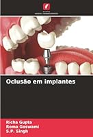 Oclusão em implantes (Portuguese Edition) 6208937752 Book Cover
