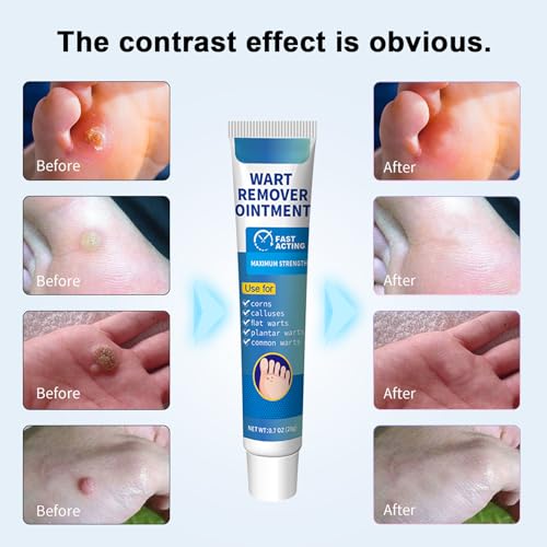 Wart Remover Ointment with 17% Salicylic Acid for Common, Flat, Plantar Warts and Corns (Blue) - Image 8