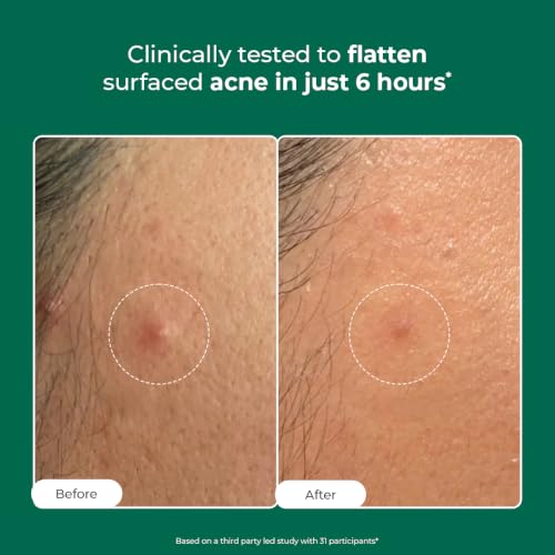 Image of Conscious Chemist Self Dissolving Microneedle Acne Patches (Pack of 24 Patches) | Painless & Effective Pimple Patches with 2% Salicylic Acid, Azelaic Acid & Niacinamide | Kills Bacteria, Reduces Redness, Scarring & Excess Sebum | Visible Results in 6 Hours