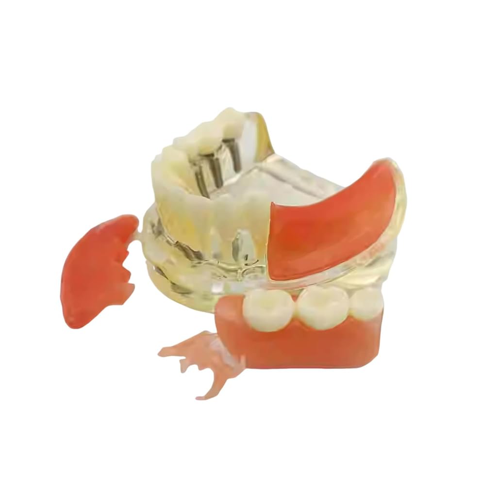 Implant-Supported Restorations Comparison Model Transparent Dental Implant Model Education Study