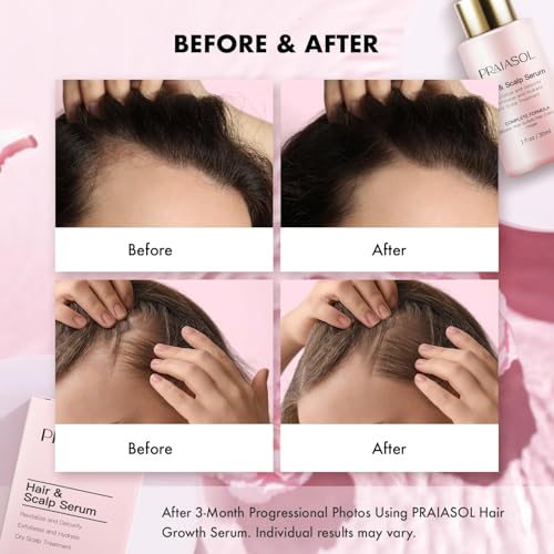 Hair Growth Serum for Women: Scalp Serum for Hair Loss Treatment, Thinning Hair Serum With Biotin,Rosemary & Peptide, Hair Thickening Products - Image 5