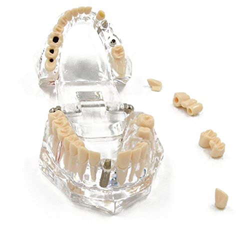 Modèle dentaire de restauration Hrippy pour comprendre l'implant