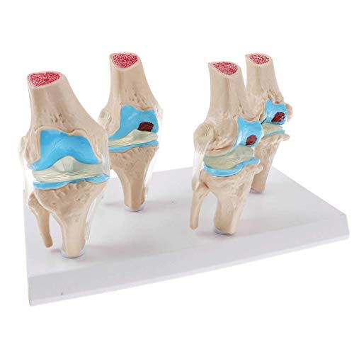 Modèle articulaire du genou pour expliquer l'usure de l'articulation aux patients