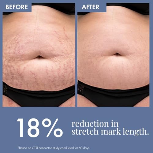 Image of ThriveCo Post Pregnancy Care Combo - Stretch Marks Expert Serum Cream 30 ml & Women's Post Partum Hair Growth Supplement (60 Capsules)