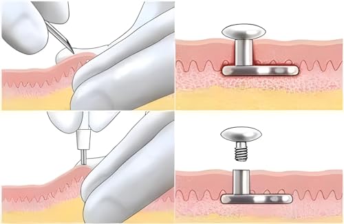 Poinçon de biopsie stérile pour un piercing précis et sans douleur - 3