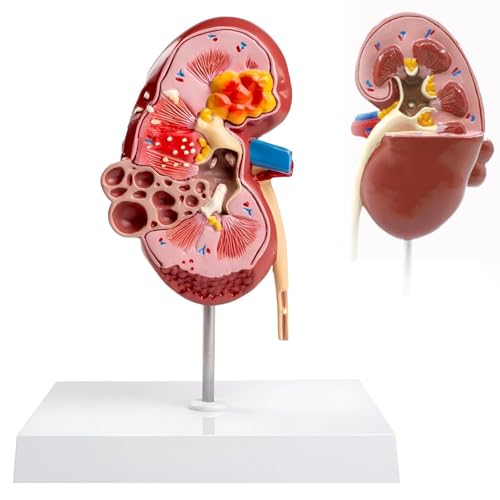 3D Kidney Diseases Model, Human Kidney Anatomy Model, Shows The Anatomy of A Normal Kidney and A Diseased Kidney, 1:1 Scale Design, with A Detachable Base, for Doctor-Patient Communication
