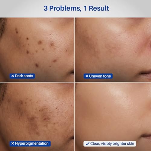 Image of DERMDOC 2% Kojic Acid Face Serum, 20ml | Dark Spots & Pigmentation Control | Brightening, Even-Tone Formula with Niacinamide + Alpha Arbutin + Glutathione | Spot Corrector Serum for Acne Marks, Tanning & Uneven Skin Tone