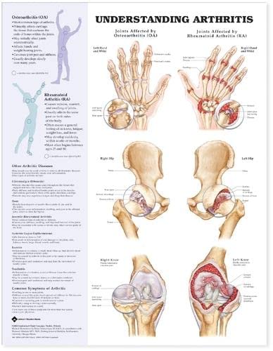 Understanding Arthritis Anatomical Chart #TOP13