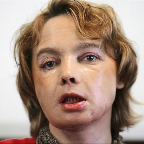 The &lsquo;guinea pigs&rsquo; who had face transplant surgery