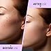 Teenitor Pimple Extractor Acne Treatment Tool Surgical Grade Blackhead Comedone Removal 2-in-1 Popper Tool for Face Nose Blackhead Extractor Tool Silver