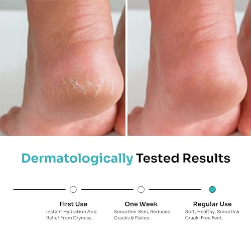 Image of Kitcoz Foot Cream Roll On with 20% Urea, 2% Lactic Acid, Glycerine & Olive Oil for Dry Feet, Cracked Heels & Diabetic Foot | Non Sticky Formulation - 50ml