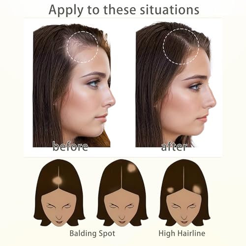 scar human hair replacement Accidental burns without hair for men women Hairline Loss Straight Tape in Replacement Toupee (Pepper Salt, 0.78"x1.5")