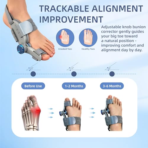 YLGNKIA Bunion Corrector for Women & Men, Adjustable Big Toe Straightener with Silicone Pad, Hallux Valgus Support for Pain Relief, Fits Left & Right Feet — view 2