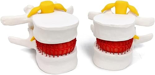 EVOTECH SCIENTIFIC Modelo de disco hernia humana, hernia anatómica de vértebras lumbares modelo de prolapso de disco para enseñanza médica,