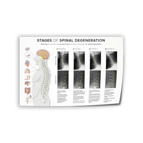 Spinal Degeneration Stages Health Poster (3) Canvas Print Wall Art