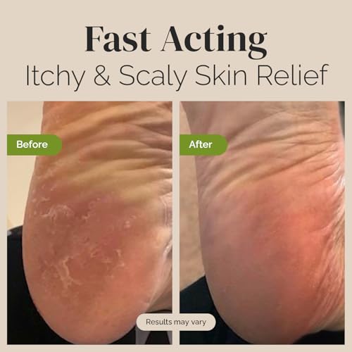 Tea Tree Oil Balm, Extra Strength, Pair Well with Jock Itch Cream, Spray, Athletes Foot, Ringworm Cream for...