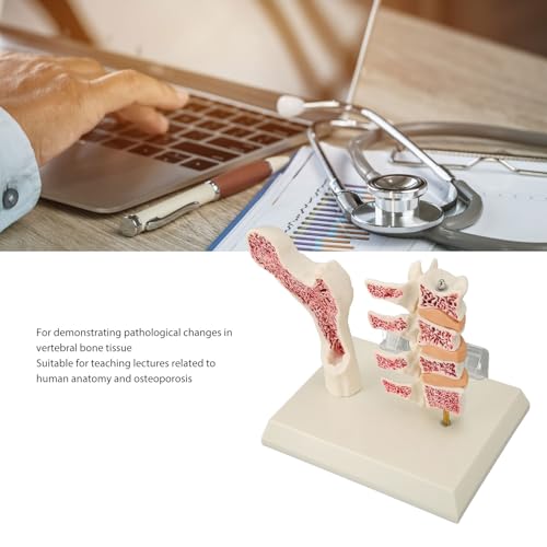 Image of ZJchao Osteoporosis Spine Model, ABS Anatomical Osteoporosis Model, Pathological Changes Visualization Versatile Learning Tool for Anatomy Education Constructed