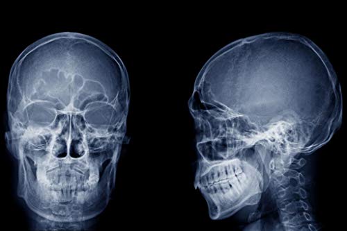 Laminated Human Skull X ray Image Front and Side Lateral View Skeleton Anatomy Medical Photo Poster Dry Erase Wall Art 12x18