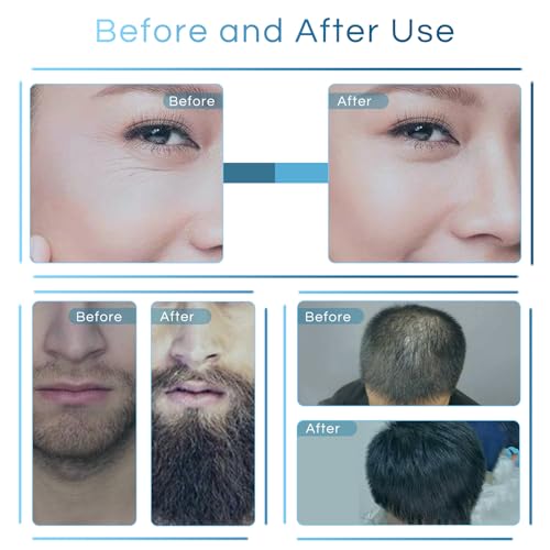 Dr.roller Einstellbar Microneedling Derma Stamp, Dermastamp 0-3,0 mm, Microneedling Pen mit 140 Titan Mikro Nadeln für Haare, Bartwuchs, Gesicht, Körper