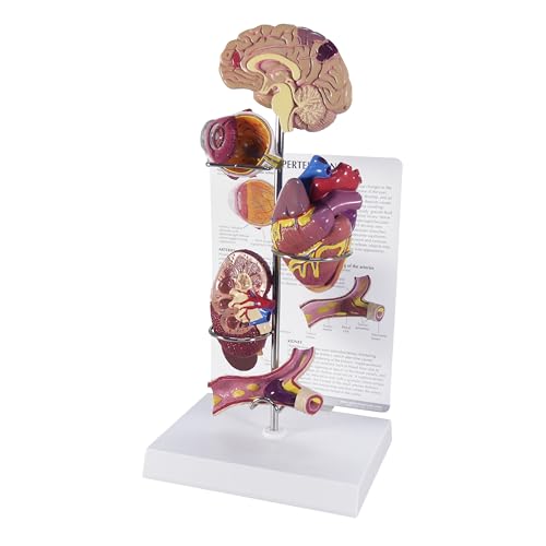 GPI Anatomicals - Hypertension Model Set, Replica for Human Anatomy and Physiology Education,...