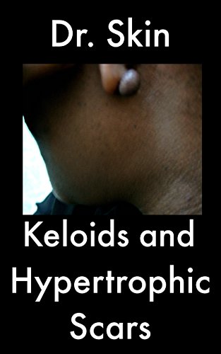 Keloids and Hypertrophic Scars (English Edition)