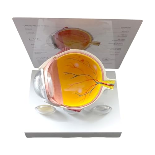 Ojo humano y modelo de anatomía ocular patológica para docencia