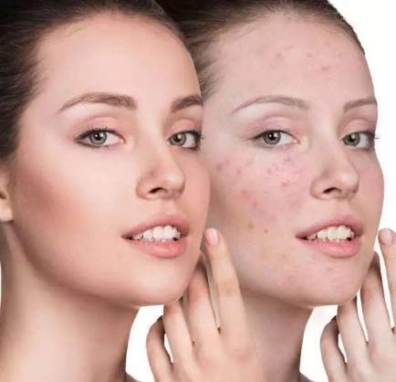 YAFU (TAIWAN) Speacial Acne Cream, Acne Scar Cream, Herbal formula non-irritating，Acne Treatment Serum, Spots Acne Treatment Blackhead Whitening Cream. 4g