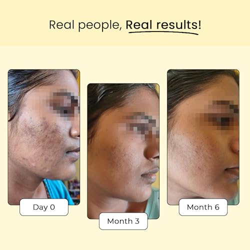 Dr.Su Skin Glow Supplement For Healthy And Glowing Skin |For Men and Women|Glutathione |Vitamin E |For Dull And Uneven Skin Tone, Pigmentation And Dark Spots Removal - Pack of 1