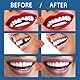 JAWUZ Zahnreparaturset, zahnersatz selber Machen,Temporary Tooth Repair zur Fixierung, Füllung fehlender, abgebrochener Zähne, 25 g