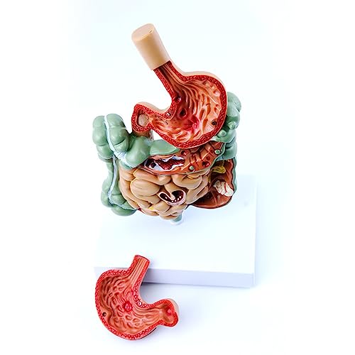 Modèle de système digestif AMITD pour comprendre le côlon pathologique - 4