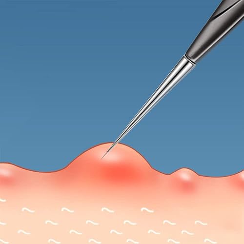 Miniatura 3 de Paquete de 2 herramientas de extracción de puntos negros y manchas para esteticistas, herramientas profesionales de extracción de poros para nariz y