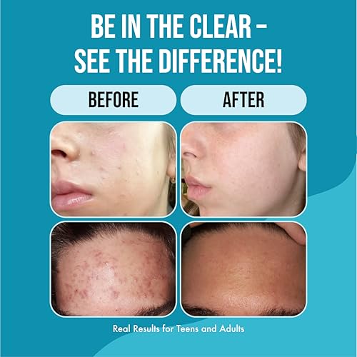 Teenology Teen Shampoo – Avoid Acne Breakouts, Non-Comedogenic, For Dry & Oily Scalps, Sulfate & Paraben Free, Natural Botanical Extracts, for Clear Skin & Healthy Hair, 16 oz – (Mint)