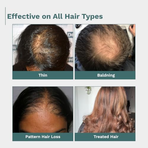 Image of Anable Anti Hair Fall & Hair Regrowth Serum | 3% Redensyl + 3% Procapil + 2% Anagain | Reduces Hair Thinning, Strengthens Hair Roots & Promotes New Growth | For Men & Women | Safe, Non-Greasy & Dermatologist Tested | 50ml