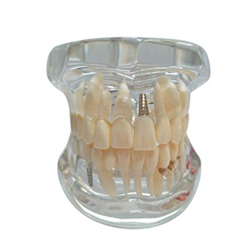 ULTECHNOVO Modelo de Simulação de Dentes Modelo Anatômico de Dentes Humanos Transparente Doença Dent