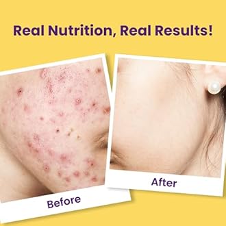 Chicnutrix Super C - Natural Vitamin C & Zinc for Clear & Acne Free Skin | 1000mg Amla Extracts|For Women & All skin types| Orange Flavour | 40 Effervescent Tablets