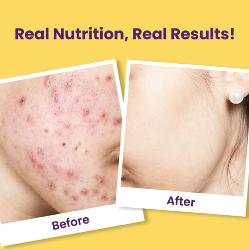 Chicnutrix Super C - Natural Vitamin C & Zinc for Clear & Acne Free Skin | 1000mg Amla Extracts|For Women & All skin types| Orange Flavour | 40 Effervescent Tablets