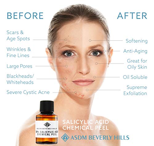 ASDM Beverly Hills 20% Salicylic Acid Peel |1 Ounce|