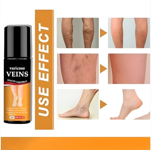 Image of Original Varicose Veins Relief Spray (30ml) - Natural Herbal Formula to Reduce Leg Pain & Swelling | Improves Blood Circulation for Tired Legs & Ankles | Fast-Acting & Easy to Use (Pack of 1)
