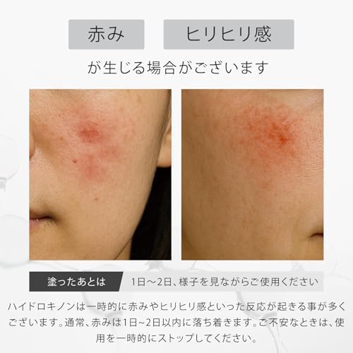 idio SLASH ハイドロキノンクリーム 6.0%