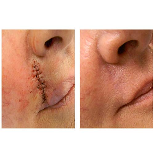 Strataderm 10g Gel De Silicone Tratamento De Cicatrizes