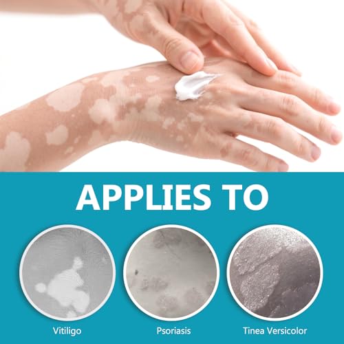Vitiligo Creme, Natürliche Pflanzenextrakte, Mildert sanft und wirksam weiße Flecken, Verbessert die Pigmentierung, Repariert die Hautbarriere, Für alle Hauttypen geeignet, 20 g