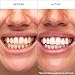 Hismile V34 Whitening Strips, Teeth Whitening Strips, Purple Tooth Whitening, Purple V34 Whitening Strips, Tooth Stain Treatment, Combining Whitening and Colour Correction