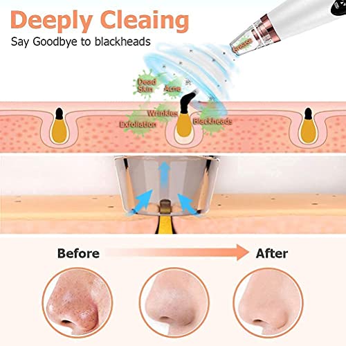 Image of 6-in-1 Blackhead Remover Machine with 6 Suction Heads | Electric Blackhead & Whitehead Remover Vacuum | Deep Pore Cleaner, Acne Comedone Extractor, Facial Skin Care Tool for Men & Women