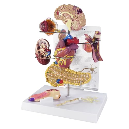 GPI Anatomicals - Type II Diabetes Model Set, Replica for Human Anatomy and Physiology Education, Anatomy Model for Doctor's Offices and Classrooms, Medical Learning Resources