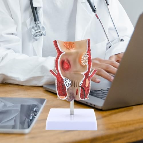 Pathologies humaines du modèle de rectum pour enseignement et anatomie médicale