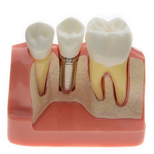 AZDENT® Dental Model Implant Analysis Crown Bridge Demonstration Teeth Model for Education