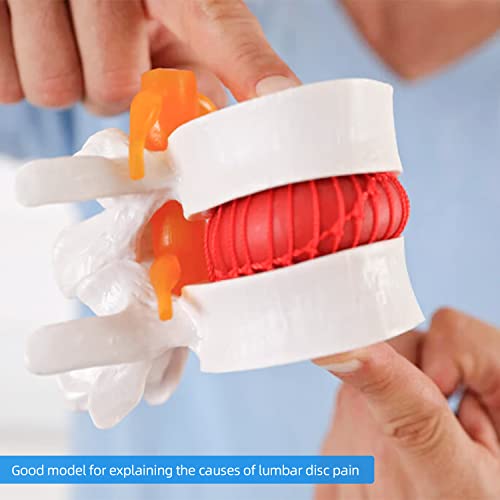 Image of Disc Herniation Model - 1.5X Lumbar Herniated Disc Model Vertebral Spine Anatomical Medical Model