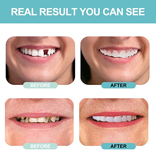 Fake Teeth, Dentures Teeth For Women And Men, Dental Veneers For Temporary Teeth Restoration, Nature And Comfortable, Protect Your Teeth And Regain Confident Smile(2Pcs) #TOP4