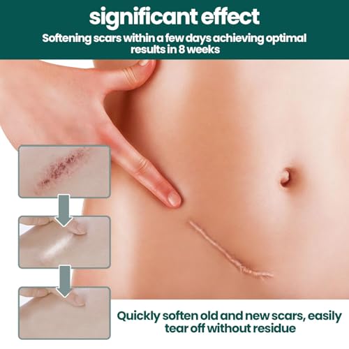 Bobopack Cerotti Silicone Cicatrici, 4X150Cm Fogli Di Silicone Per Cicatrici, Rotolo Di Nastro In Silicone Morbido,Scar Sheets,Per Cicatrici Causate Da Cesareo, Chirurgia, Ustioni - 5