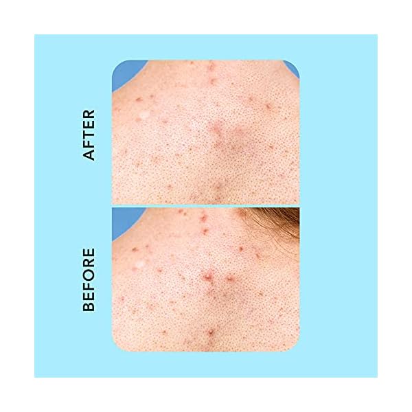 Rael Pimple Patches, Miracle XL Spot Control Cover - Hydrocolloid Acne Patch for Face, Zits & Blemish, Back and Body, Korean Skin Care, Vegan, Cruelty Free (6 Count)